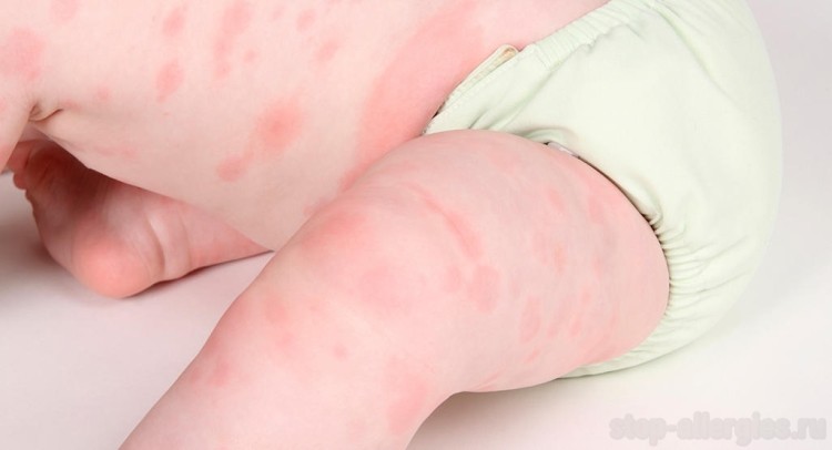 Как долго проходит сыпь от аллергии