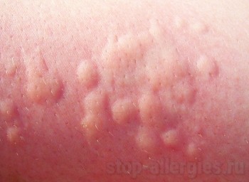 Как долго проходит сыпь от аллергии