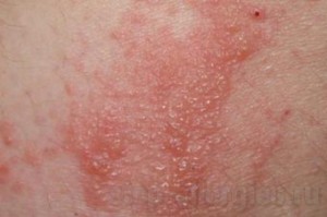 аллергический дерматит и лишай thumbnail