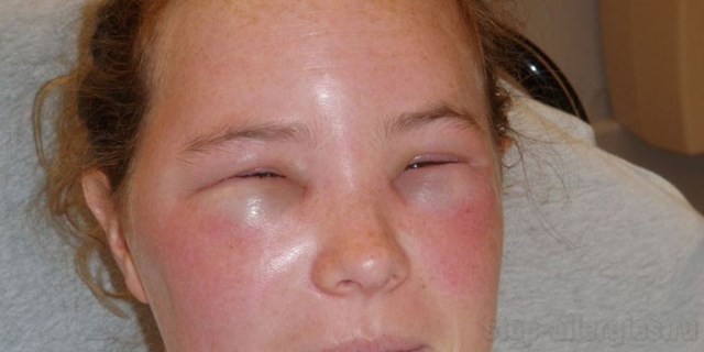 Сильно опухли веки аллергия