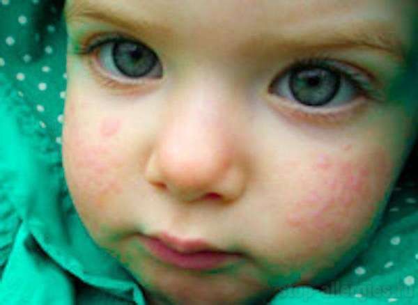 Непереносимость молочного белка • Аллергия и аллергические реакции