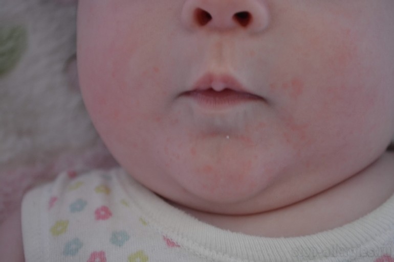 Есть ли аллергия на гречку. Аллергия на смесь у новорожденного. Аллергия на смесь у грудничка. Сыпь на смесь у новорожденных.