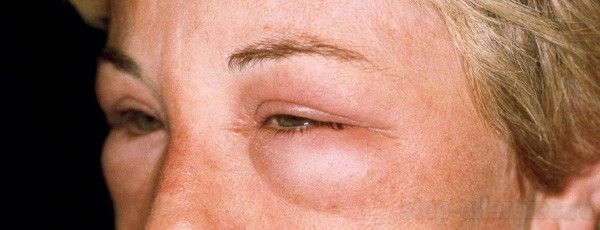 Аллергия кожи лица на крем