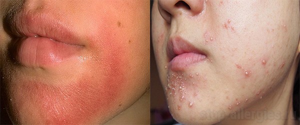 Чем успокоить кожу лица после аллергии