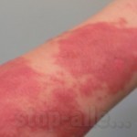 аллергический дерматит на моющие средства