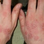 аллергический дерматит на моющие