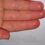 аллергический дерматит на моющие thumbnail