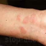 аллергический дерматит на моющие