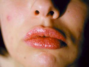 Аллергия на губную помаду симптомы thumbnail