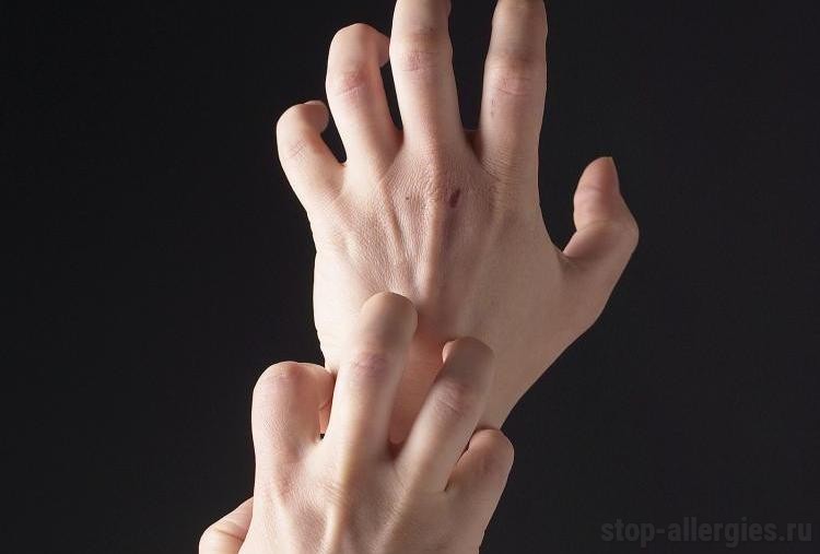 На что может быть аллергия если чешуться руки thumbnail