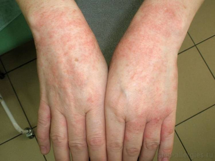 Как вылечить руки от аллергии на руках от моющего thumbnail