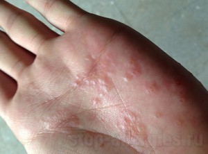 Пузырьки на руке у ребенка при аллергии thumbnail