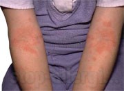 аллергический дерматит и лямблии