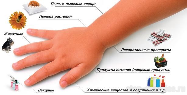 Аллергия проявления - Как вылечить аллергию Аллергия проявления - Как вылечить аллергию
