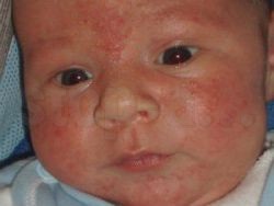 Аллергия на кошек у детей Официальный сайт Huggies Аллергия на кошек у детей Официальный сайт Huggies
