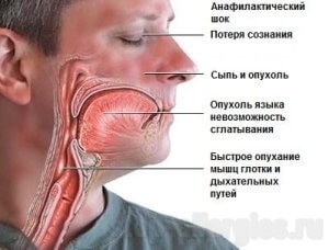 Аптечка при анафилактическом шоке состав - Как вылечить аллергию Аптечка при анафилактическом шоке состав - Как вылечить аллергию