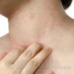 Бронхиальная астма приступ удушья - Как вылечить аллергию Бронхиальная астма приступ удушья - Как вылечить аллергию