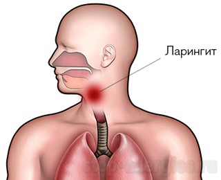 Как вылечить аллергию дыхательных путей thumbnail