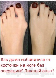 Дисгидротическая экзема - Как вылечить аллергию Дисгидротическая экзема - Как вылечить аллергию