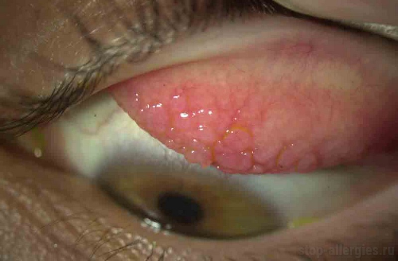 Глазные капли при аллергии • Аллергия и аллергические реакции
