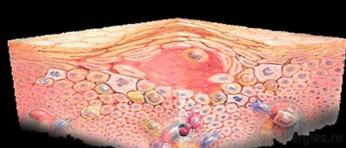 Как отличить грибок на руках от дерматита