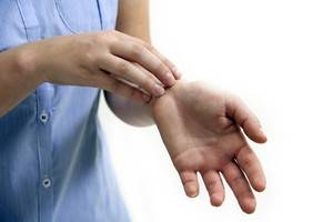 Себорейный дерматит на кистях рук в руки