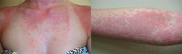 аллергический дерматит и лишай