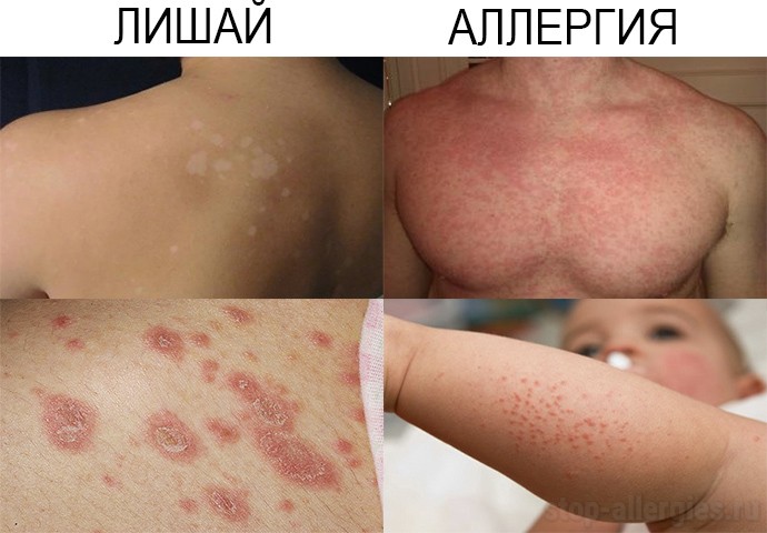 аллергический дерматит или лишай