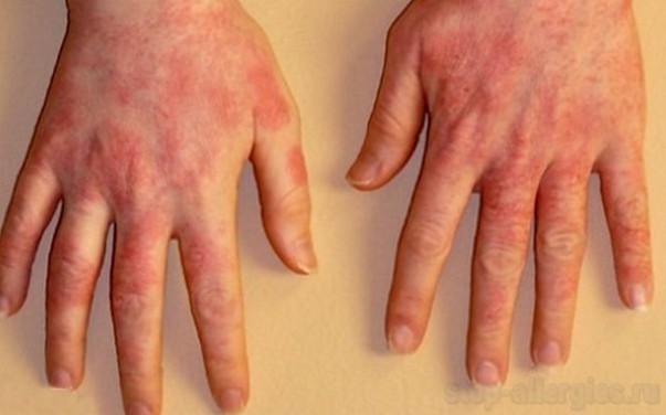 Аллергия на тгк содержание тгк конопли мужские