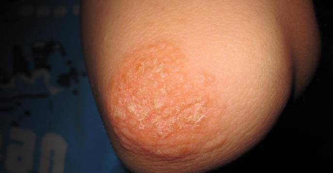 Как лечить дерматит на локтях и коленях