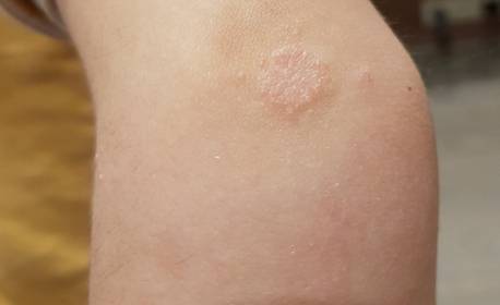 Как лечить дерматит на локтях и коленях thumbnail