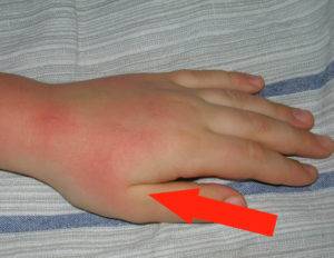 Что такое себорейный дерматит на руках