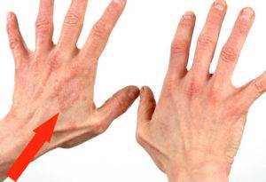 Себорейный дерматит на руках как его лечить thumbnail